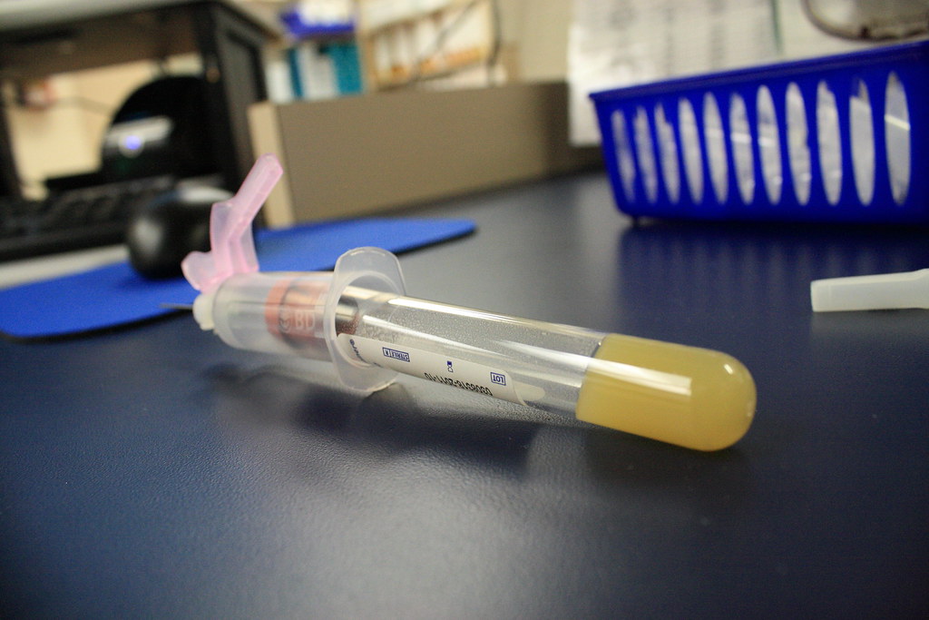 Asie Centrale Santé HIV VIH Propagation Test
